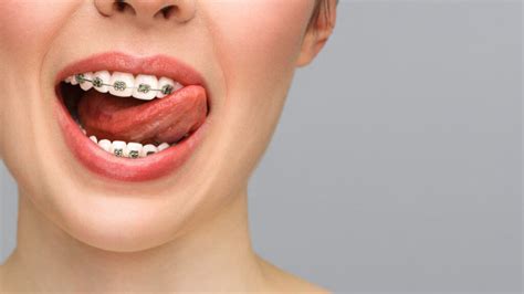 brackets de metal precio|brackets invisibles precio.